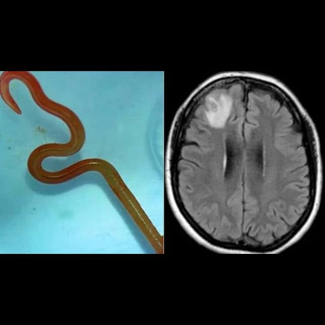 A live parasitic worm found in an Australian woman's brain shocks medical experts, highlighting the risk of zoonotic diseases from animals to humans.