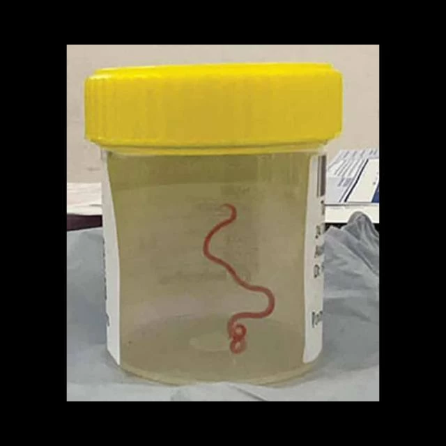 Unprecedented Discovery: Live Parasitic Worm Found in Australian Woman's Brain
