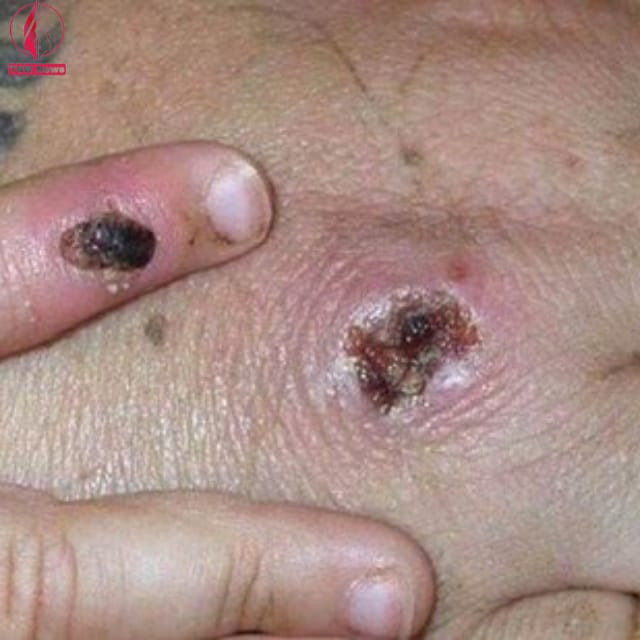 The disease Monkeypox is characterized by red rashes with inflammation in the skin due to enlargement of lymphatic nodes and vessels. This is accompanied 