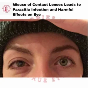 Misuse of Contact Lenses