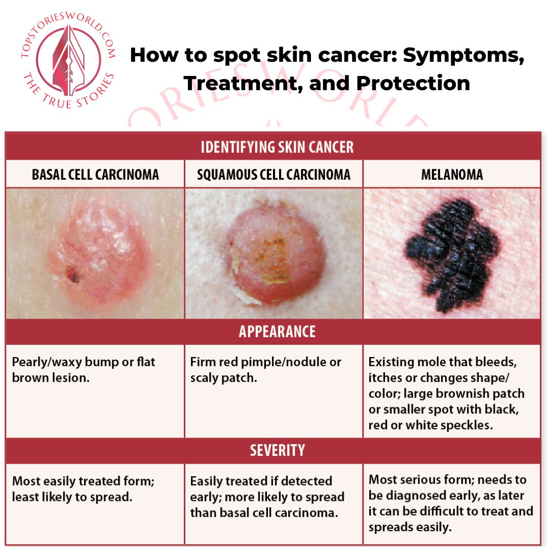 How to spot skin cancer: Symptoms, Treatment, and Protection